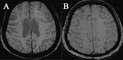 Presence of cerebral microbleeds is associated with cognitive decline in acromegaly